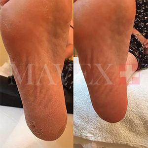 Mavex callus calluspeeling centro estetico nouvelle esthetique frattamaggiore napoli manicure piedi mani pedicure piedicure cura maschera crema bendaggio