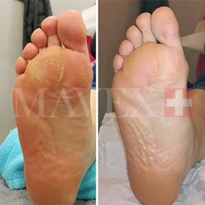 Mavex callus calluspeeling centro estetico nouvelle esthetique frattamaggiore napoli manicure piedi mani pedicure piedicure cura maschera crema bendaggio